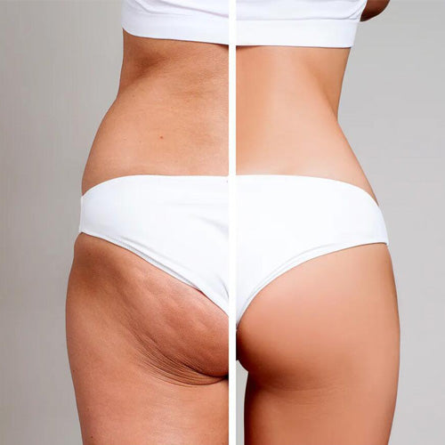 Top Anti-Cellulite Cream: The 10 Most Important Questions Asks Before Buying